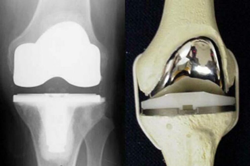 knee joint replacement for osteoarthritis