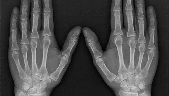 radiography for the diagnosis of arthritis and osteoarthritis