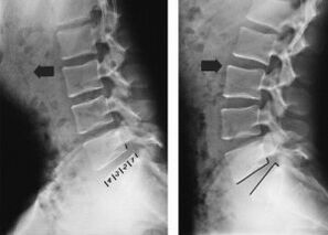 displacement of the vertebrae in thoracic osteochondrosis