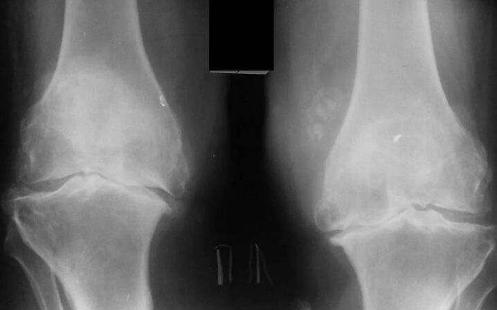 Osteoarthritis of the knee joint 2 degrees