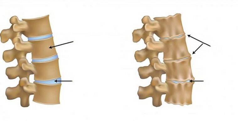 Ischemic syndrome for osteochondosis