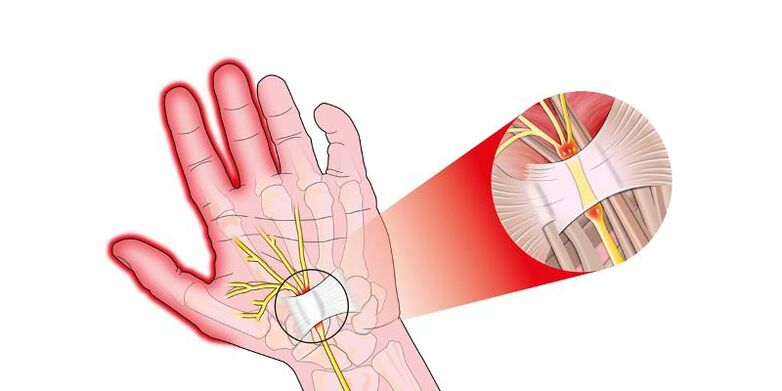 Pain in the joints of the fingers with resaltrosis
