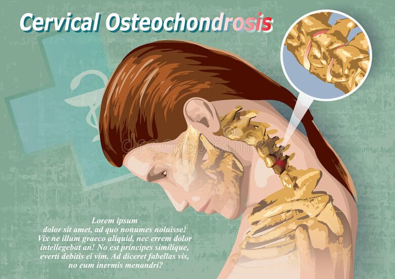 Cervical osteochondosis is a disease of cartilage tissue