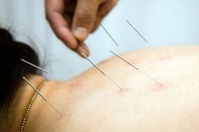 Acupuncture for osteochondrosis